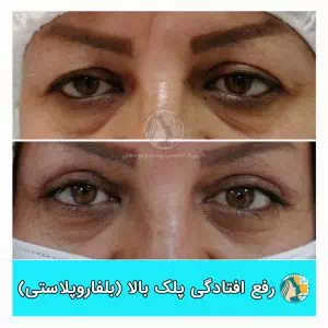 بلفاروپلاستی