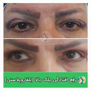 بلفاروپلاستی