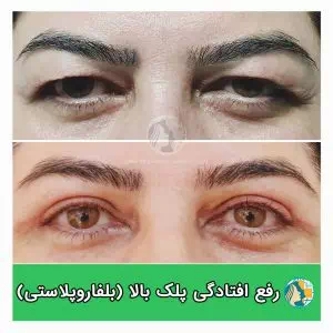 بلفاروپلاستی